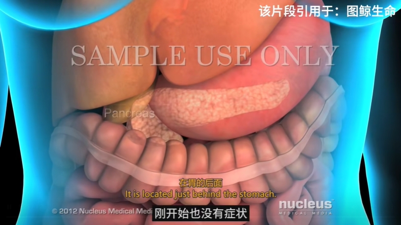 平扫ct+AI首次实现检测早期胰腺ai的论文